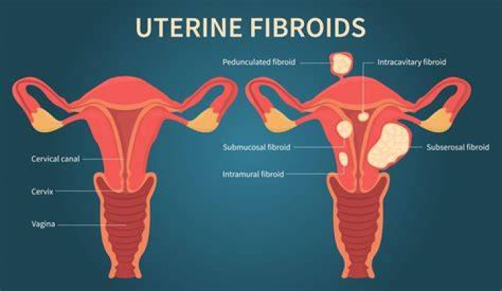 Can uterine fibroids burst?