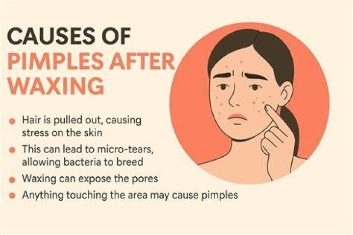 How do you treat facial waxing rash?