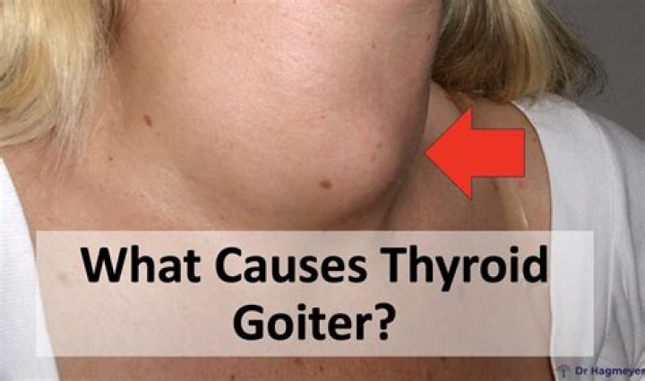 What is a goiter and how is it treated?