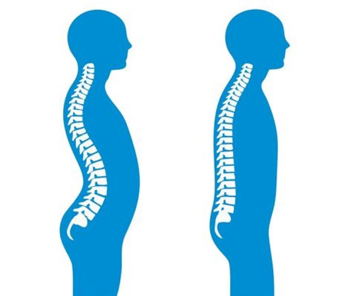 What is lumbar lordosis is reduced?