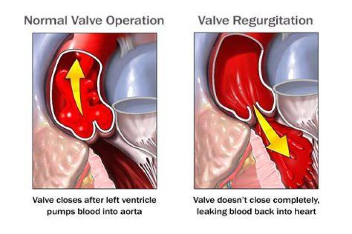 What is regurgitation? | ContextResponse.com